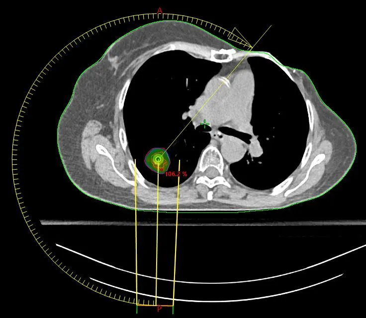 Radiocirugía Estereotáctica Extracraneal