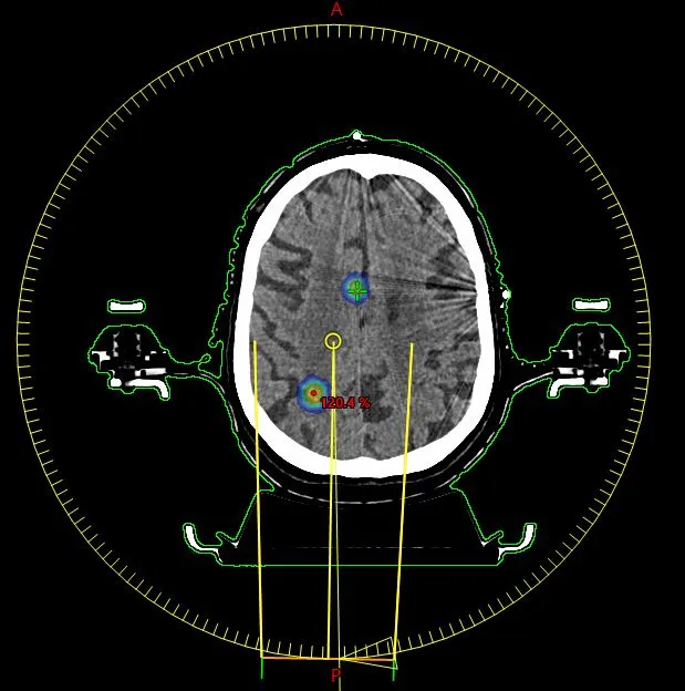 Radiocirugía Estereotáctica Intracraneal